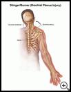 Thumbnail image of: Stinger/Burner (Brachial Plexus Injury): Illustration