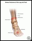 Thumbnail image of: Stress Fractures of the Leg and Foot: Illustration