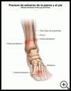 Thumbnail image of: Stress Fractures of the Leg and Foot: Illustration
