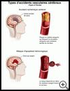 Thumbnail image of: Stroke, Types of: Illustration
