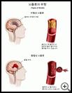 Thumbnail image of: Stroke, Types of: Illustration