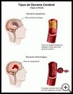 Thumbnail image of: Stroke, Types of: Illustration