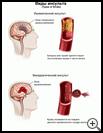 Thumbnail image of: Stroke, Types of: Illustration
