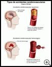 Thumbnail image of: Stroke, Types of: Illustration
