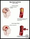 Thumbnail image of: Stroke, Types of: Illustration