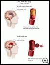 Thumbnail image of: Stroke, Types of: Illustration