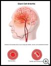 Thumbnail image of: Giant Cell Arteritis: Illustration