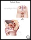 Thumbnail image of: Testicular Cancer: Illustration