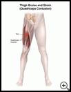 Thumbnail image of: Thigh Bruise and Strain (Quadriceps Contusion): Illustration