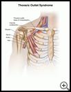 Thumbnail image of: Thoracic Outlet Syndrome: Illustration