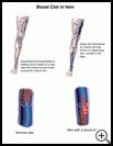 Thumbnail image of: Blood Clot in Vein: Illustration