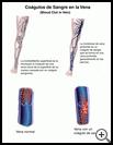 Thumbnail image of: Blood Clot in Vein: Illustration