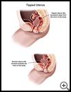 Thumbnail image of: Tipped Uterus: Illustration
