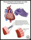 Thumbnail image of: Laser Revascularization of the Heart: Illustration