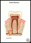 Thumbnail image of: Tooth Abscess: Illustration
