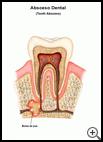 Thumbnail image of: Tooth Abscess: Illustration