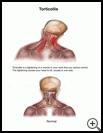 Thumbnail image of: Torticollis: Illustration