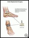 Thumbnail image of: Ankle Replacement Surgery: Illustration