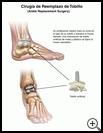 Thumbnail image of: Ankle Replacement Surgery: Illustration