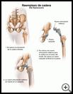 Thumbnail image of: Hip Replacement: Illustration
