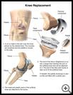 Thumbnail image of: Knee Replacement: Illustration