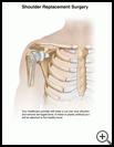Thumbnail image of: Shoulder Replacement Surgery: Illustration