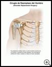 Thumbnail image of: Shoulder Replacement Surgery: Illustration