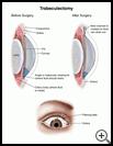Thumbnail image of: Trabeculectomy: Illustration