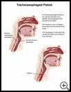 Thumbnail image of: Tracheoesophageal Fistula in Adults: Illustration