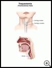 Thumbnail image of: Tracheostomy Tube: Illustration