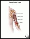 Thumbnail image of: Triceps Tendon Injury: Illustration