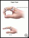 Thumbnail image of: Trigger Finger: Illustration
