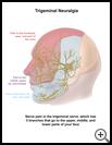 Thumbnail image of: Trigeminal Neuralgia: Illustration