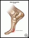 Thumbnail image of: Turf Toe: Illustration