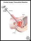 Thumbnail image of: Prostate Surgery: Transurethral Resection (TURP): Illustration