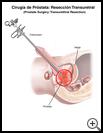 Thumbnail image of: Prostate Surgery: Transurethral Resection (TURP): Illustration