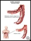 Thumbnail image of: Ulcerative Colitis: Illustration