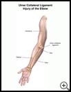 Thumbnail image of: Ulnar Collateral Ligament Injury of the Elbow: Illustration
