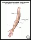 Thumbnail image of: Ulnar Collateral Ligament Injury of the Elbow: Illustration