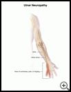 Thumbnail image of: Ulnar Neuropathy: Illustration