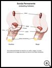 Thumbnail image of: Indwelling Catheter: Illustration