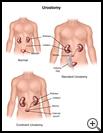 Thumbnail image of: Urostomy: Illustration