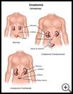 Thumbnail image of: Urostomy: Illustration