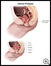 Thumbnail image of: Uterine Prolapse: Illustration