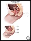Thumbnail image of: Uterine Prolapse: Illustration