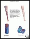 Thumbnail image of: Varicose Veins: Illustration