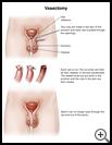 Thumbnail image of: Vasectomy: Illustration
