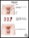 Thumbnail image of: Vasectomy: Illustration