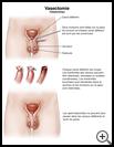 Thumbnail image of: Vasectomy: Illustration