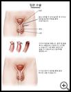 Thumbnail image of: Vasectomy: Illustration